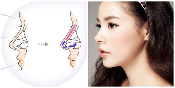 Nâng mũi Hàn Quốc là biện pháp cải thiện sống mũi được ưa chuộng và phổ biến hiện nay.