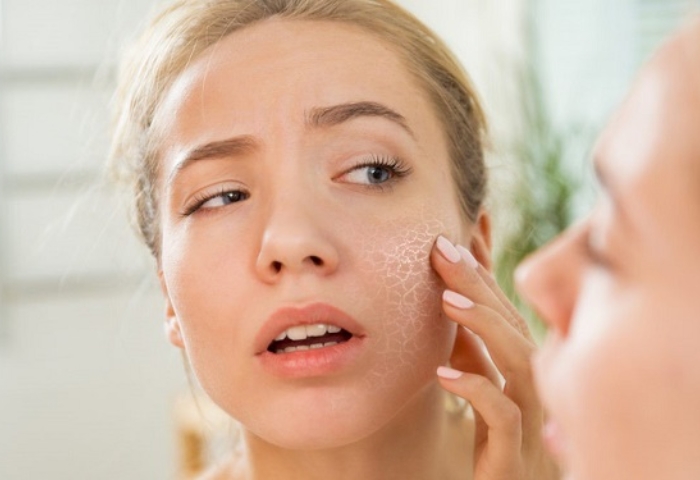 Hướng dẫn cách chăm sóc da sau khi lột da mặt bằng chất hóa học